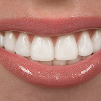 Dental bonding is a great way to make a minor correction