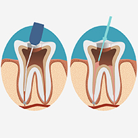 Root canal process