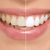 Professional teeth whitening can give you the best results