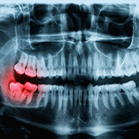 Mouth X-Ray focused on the wisdom teeth