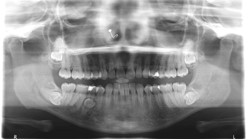 clipart tooth xray - photo #47