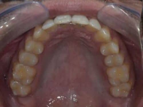 Diastema Closure invisalign after treatment