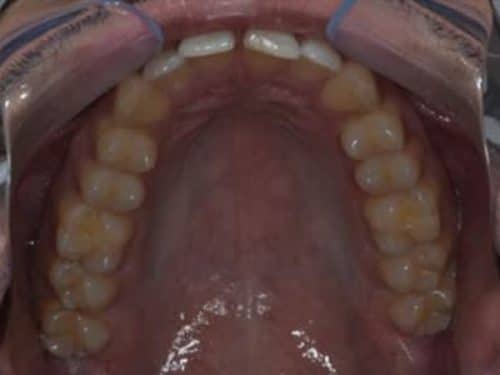 Diastema Closure invisalign before treatment