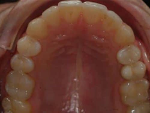 Narrow arch invisalign after treatment