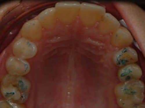 Narrow arch invisalign before treatment