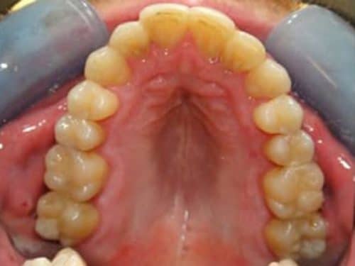 Not enough space invisalign after treatment