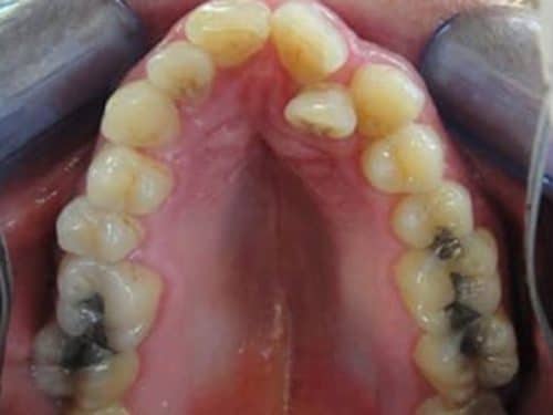 Not enough space invisalign before treatment