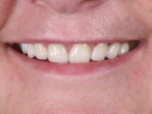 Patient after closeup diastema closure porcelain veneers