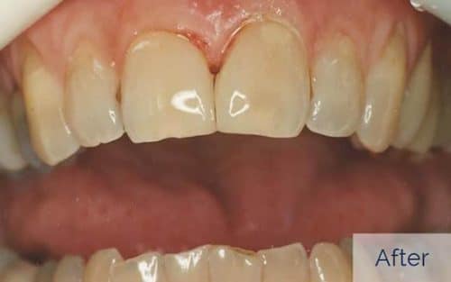 Patient after front teeth cosmetic bonding