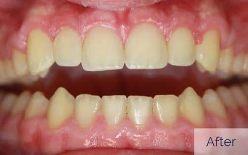 Patient after gapped teeth cosmetic bonding