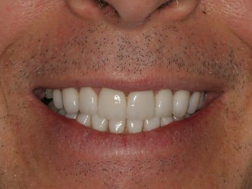 Patient after reshape teeth porcelain veneers