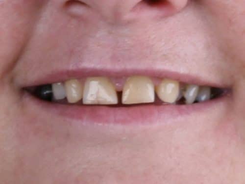 Patient before closeup diastema closure porcelain veneers