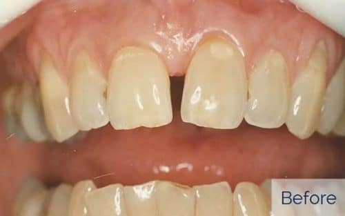 Patient before front teeth cosmetic bonding