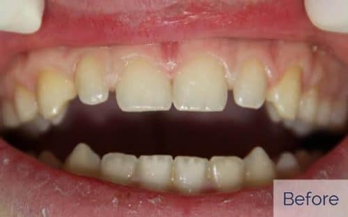 Patient before gapped teeth cosmetic bonding