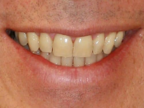 Patient before reshape teeth porcelain veneers