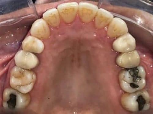 Rotating front tooth invisalign after treatment