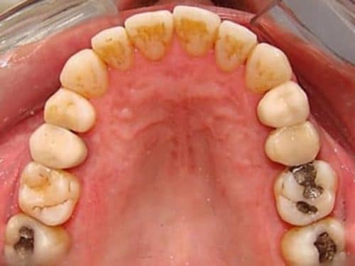 Rotating front tooth invisalign before treatment