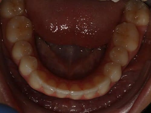 Teeth straightening with invisalign after treatment