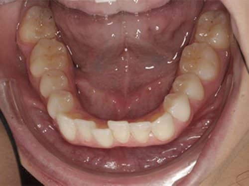 Teeth straightening with invisalign before treatment