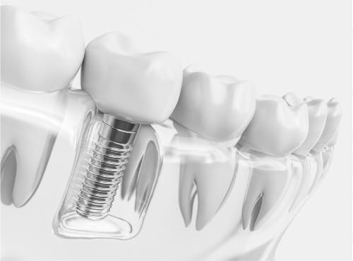 implant dentures tech image