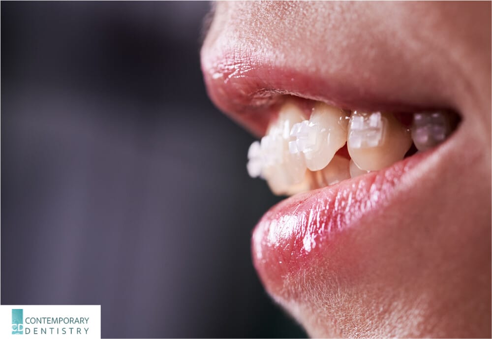 Can Invisalign Fix Overbite? | Rochester Smile Guide