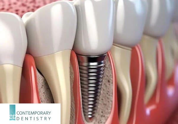 dental-implant-cross-section-model Close-up illustration of a dental implant showing the titanium screw placed in the jawbone supporting a dental crown.