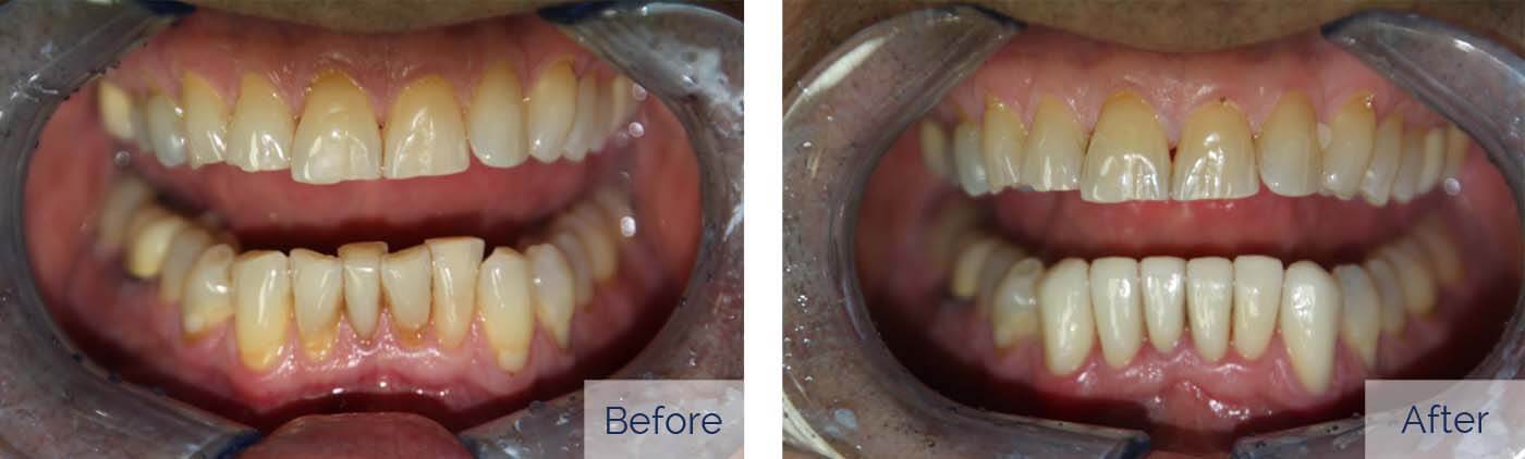 Problem: Discolored teeth Solution: Porcelain veneers