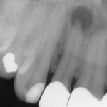 tooth infection xray