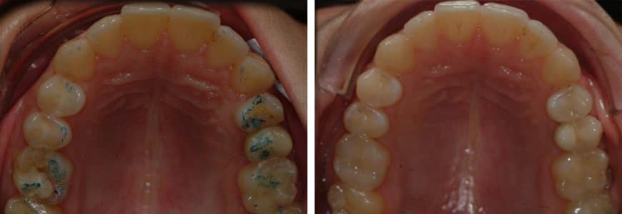 before and after Invisalign comparison fixing Diastema, Narrow Arch & Openbite