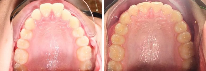 before and after Invisalign comparison fixing crowding after 7 months