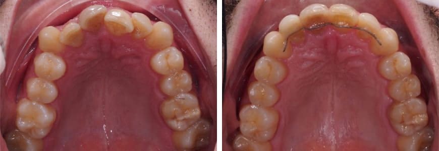 before and after Invisalign comparison fixing Anterior Crossbite