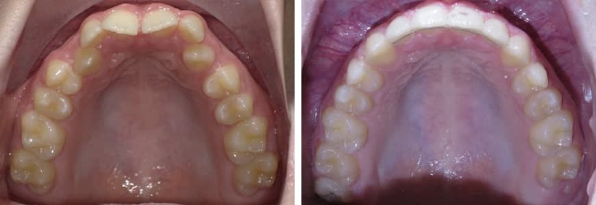 before and after Invisalign comparison fixing spacing issues between teeth
