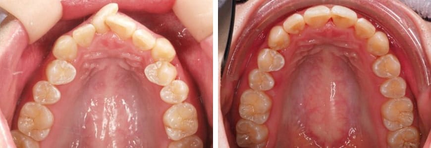Invisalign comparison fixing Rotations in a patients mouth after 10 months