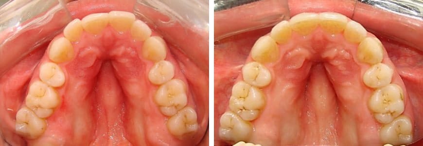 before and after Invisalign comparison showing crowding after 10 months