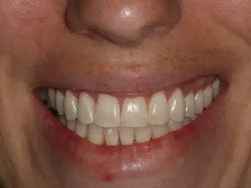 Patient closeup after teeth straightening invisalign