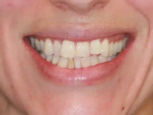 Patient closeup before teeth straightening invisalign